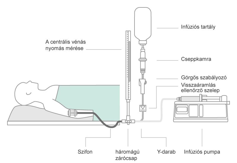 Scheme of a parallel infusion configuration. Combinations of gravity infusion and pump driven infusion in parallel bears the risk of air embolism, when gravity infusion runs dry.