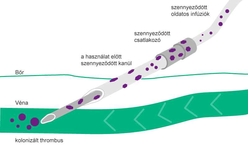 Illustration of Extra- and intraluminal route of contamination using a contaminated catheter.