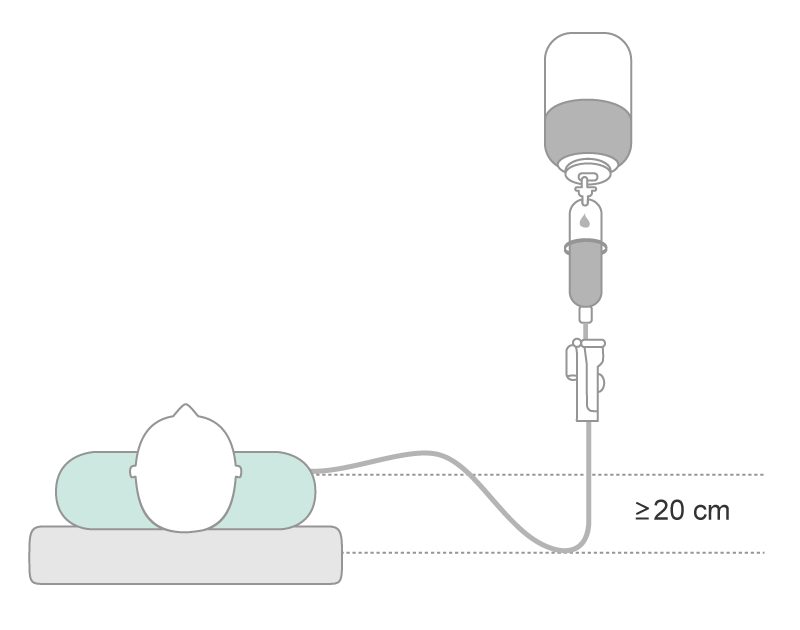 Infusion regimen with the usage of a siphon greater than 20 cm.