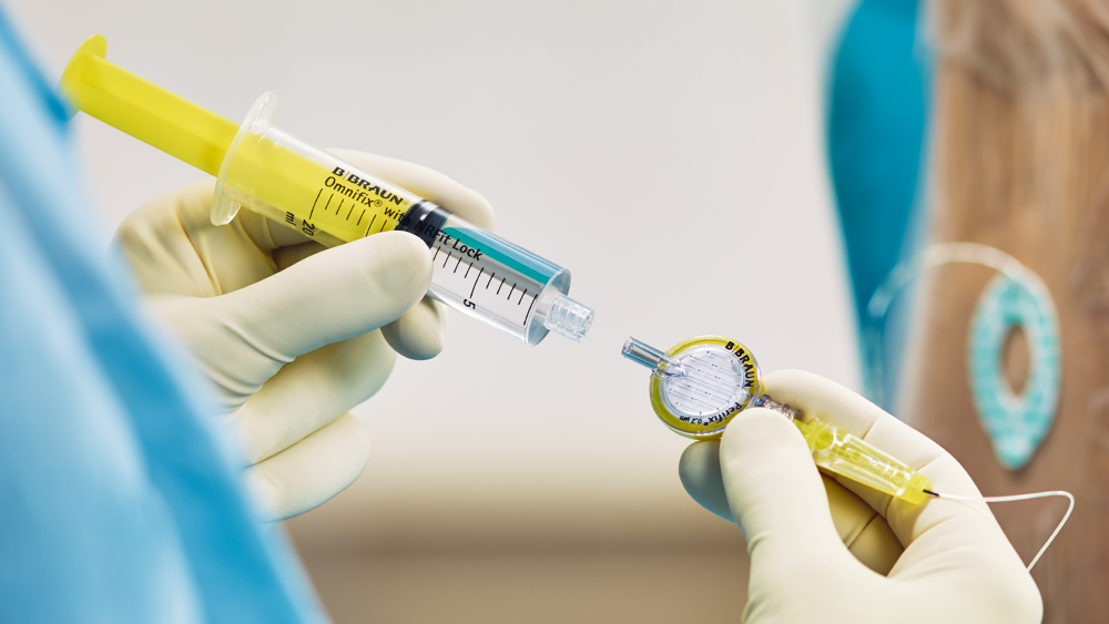 A gyógyszerrel feltöltött fecskendő egy speciális csatlakozóval rendelkező szűrőhöz csatlakozik a regionális anesztéziához.