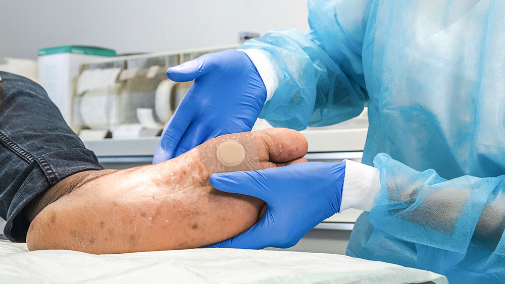 Két kesztyűt viselő kéz tart egy ragtapaszt tartalmazó diabéteszes lábat, a háttérben orvosi anyag egy orvosi szobában